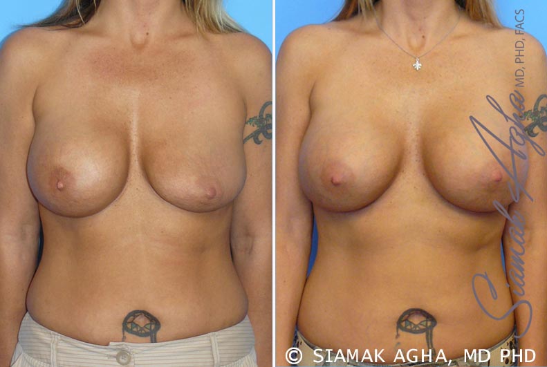 orange county breast augmentation revision patient 1 front Newport Beach, CA