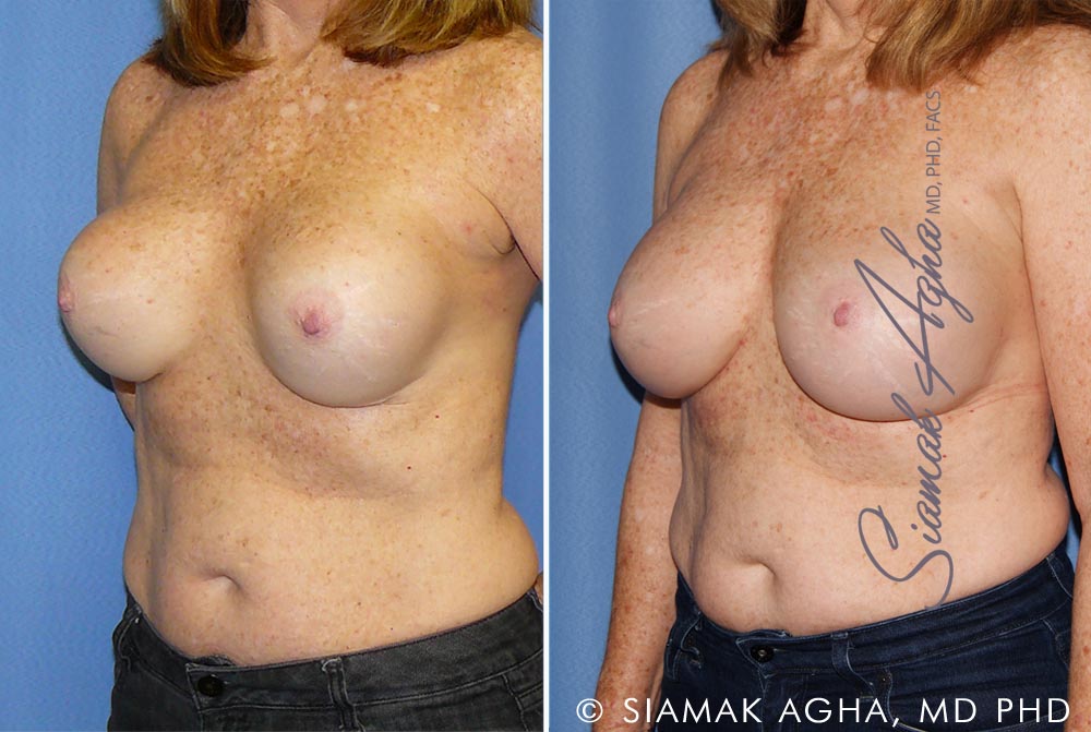 orange county breast augmentation revision patient 11 front left Newport Beach, CA