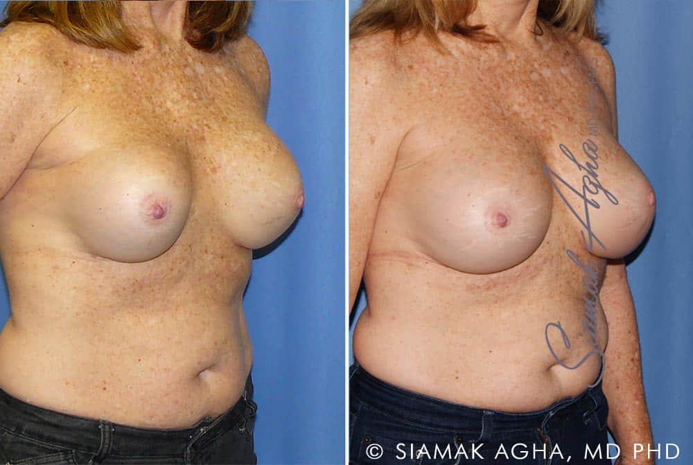 orange county breast augmentation revision patient 11 front right Newport Beach, CA