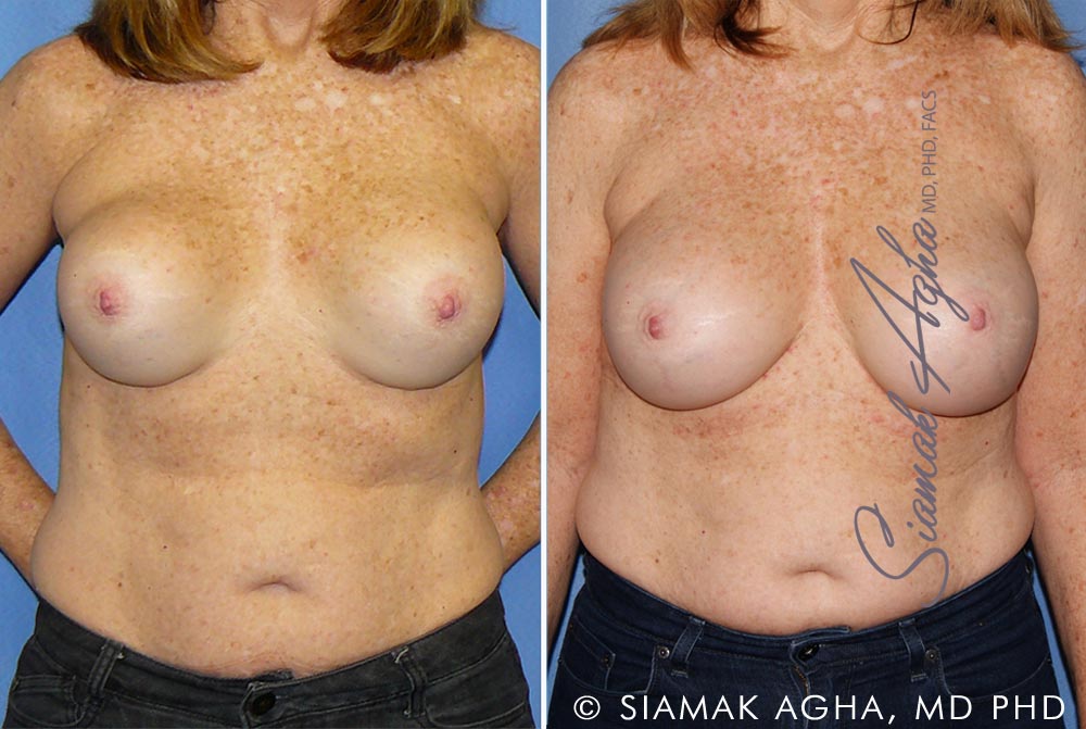 orange county breast augmentation revision patient 11 front Newport Beach, CA