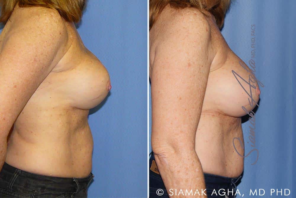 orange county breast augmentation revision patient 11 right Newport Beach, CA