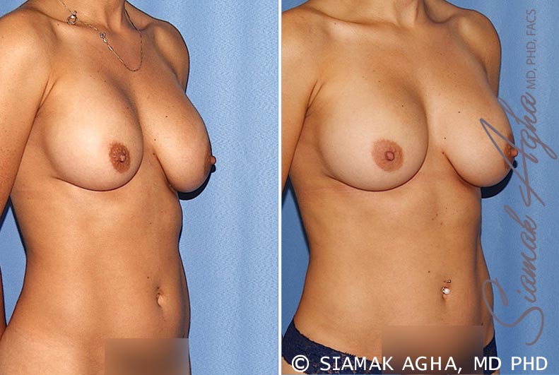 orange county breast augmentation revision patient 12 front right Newport Beach, CA