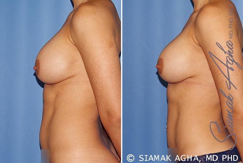 Breast Augmentation Revision Patient 12
