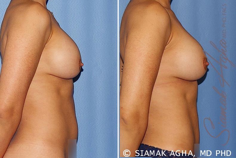 orange county breast augmentation revision patient 12 right Newport Beach, CA
