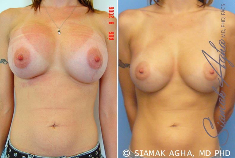 orange county breast augmentation revision patient 2 front Newport Beach, CA