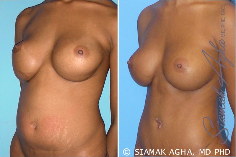 orange county breast augmentation revision patient 3 front left Newport Beach, CA