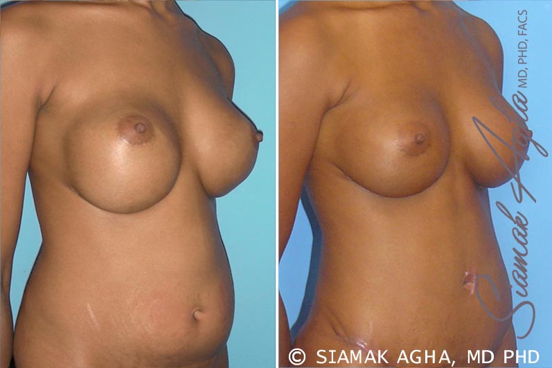 orange county breast augmentation revision patient 3 front right Newport Beach, CA
