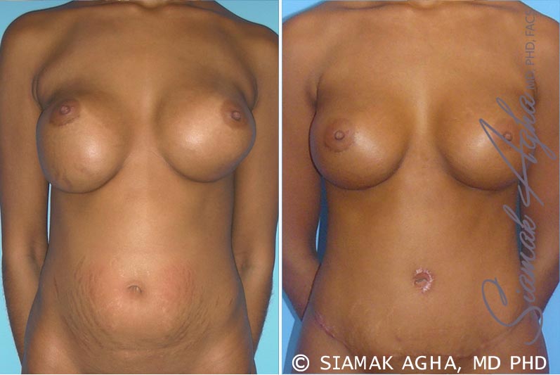 orange county breast augmentation revision patient 3 front Newport Beach, CA