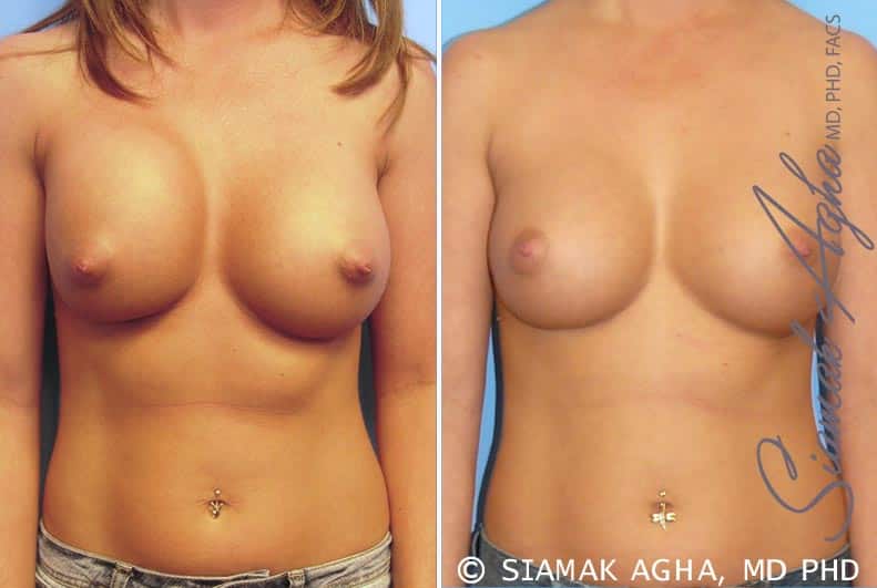 orange county breast augmentation revision patient 4 front Newport Beach, CA