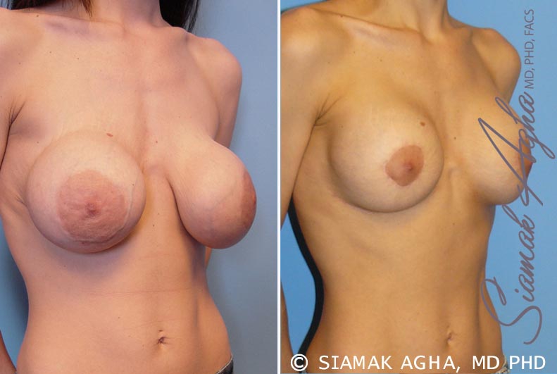 orange county breast augmentation revision patient 5 front right Newport Beach, CA