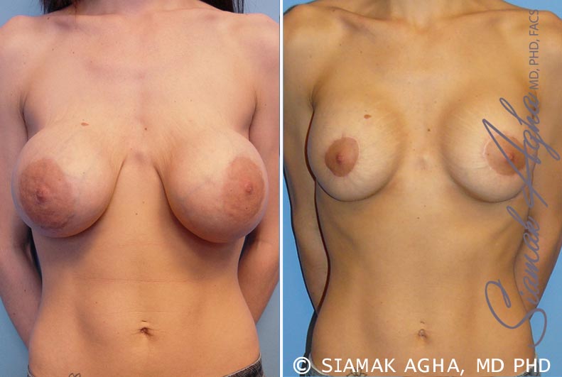 Breast Augmentation Revision Patient 5