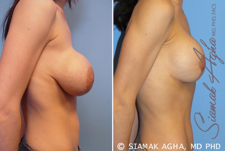 orange county breast augmentation revision patient 5 right Newport Beach, CA