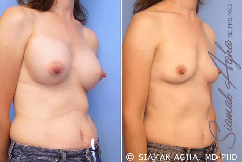 orange county breast augmentation revision patient 6 front right Newport Beach, CA