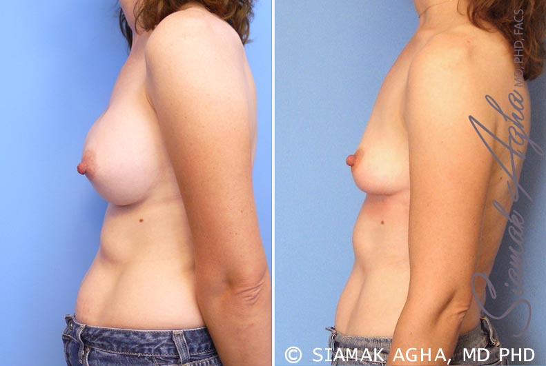 orange county breast augmentation revision patient 6 left Newport Beach, CA