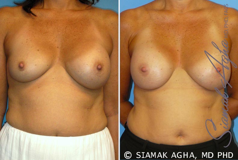 orange county breast augmentation revision patient 7 front Newport Beach, CA