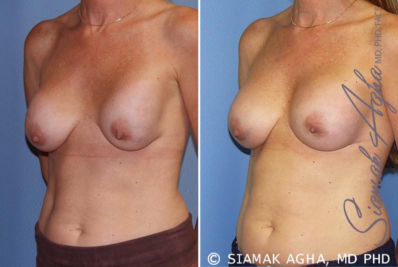 orange county breast augmentation revision patient 8 front left Newport Beach, CA