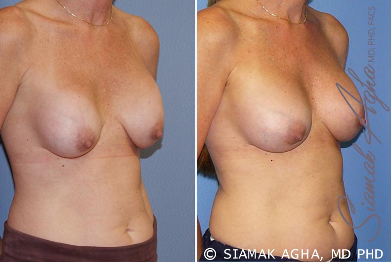orange county breast augmentation revision patient 8 front right Newport Beach, CA