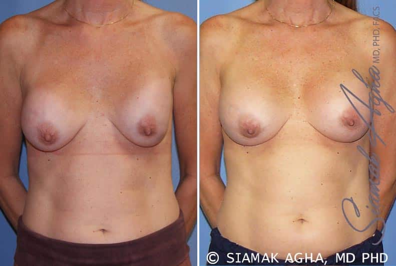 orange county breast augmentation revision patient 8 front Newport Beach, CA