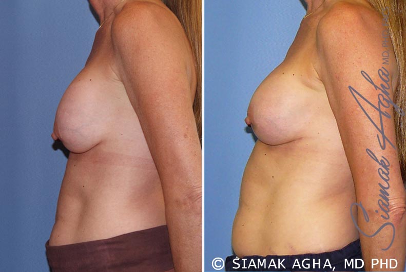 orange county breast augmentation revision patient 8 left Newport Beach, CA