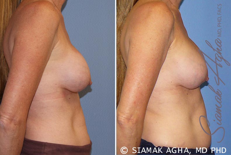 orange county breast augmentation revision patient 8 right Newport Beach, CA