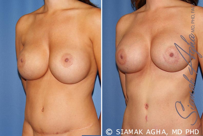 orange county breast augmentation revision patient 9 front left Newport Beach, CA