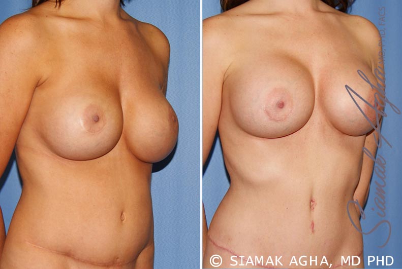 orange county breast augmentation revision patient 9 front right Newport Beach, CA