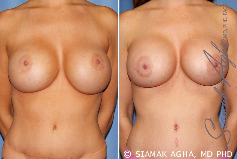 orange county breast augmentation revision patient 9 front Newport Beach, CA
