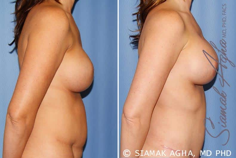 orange county breast augmentation revision patient 9 right Newport Beach, CA