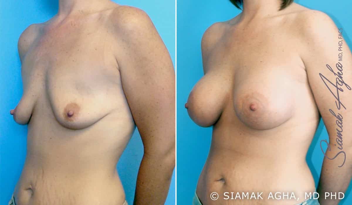 orange county breast lift with augmentation patient 1 front left Newport Beach, CA