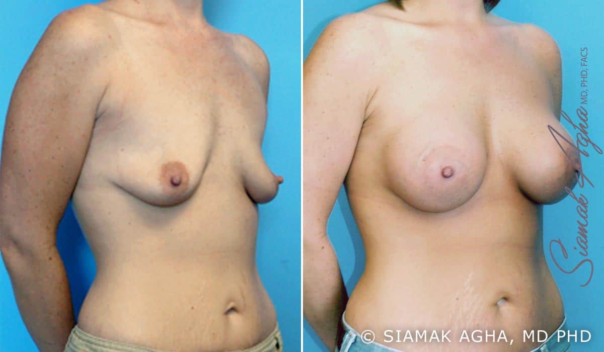 orange county breast lift with augmentation patient 1 front right Newport Beach, CA