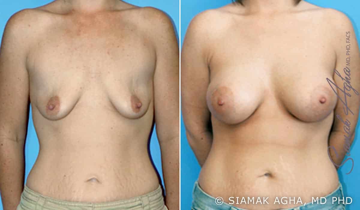 orange county breast lift with augmentation patient 1 front Newport Beach, CA