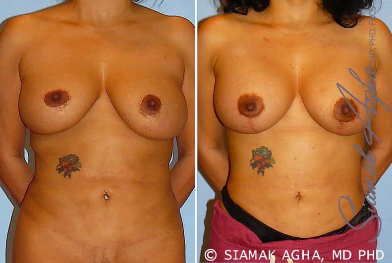 orange county breast lift with augmentation patient 10 front Newport Beach, CA