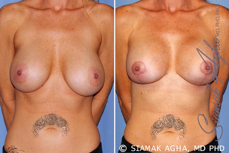 orange county breast lift with augmentation patient 11 front Newport Beach, CA