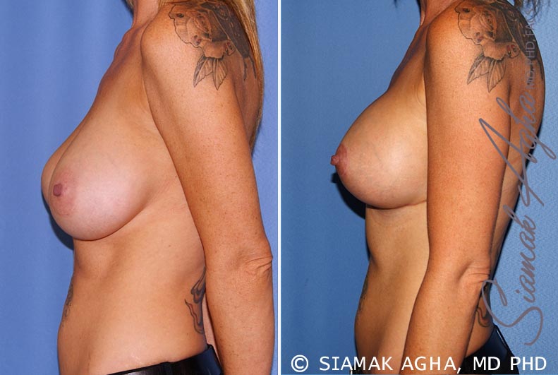 Breast Lift with Augmentation Patient 11