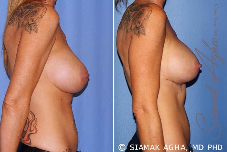 orange county breast lift with augmentation patient 11 right Newport Beach, CA