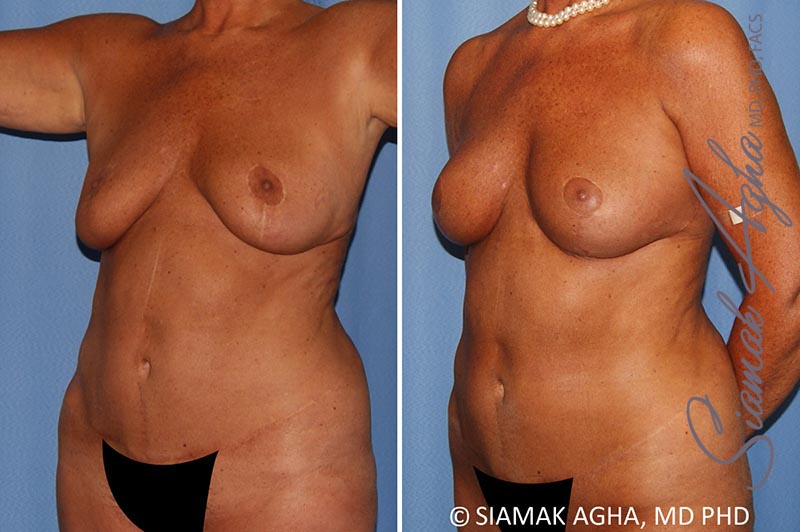 orange county breast lift with augmentation patient 12 front left Newport Beach, CA