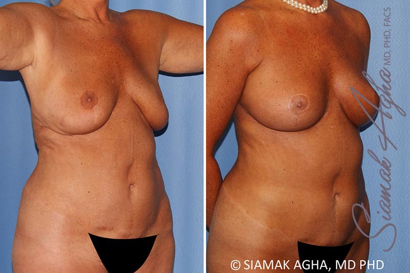 orange county breast lift with augmentation patient 12 front right Newport Beach, CA