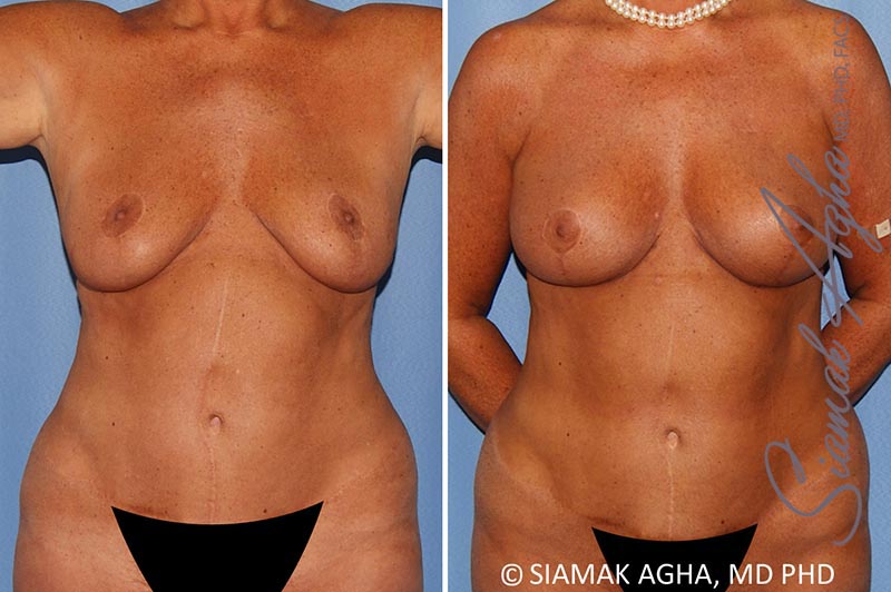 orange county breast lift with augmentation patient 12 front Newport Beach, CA