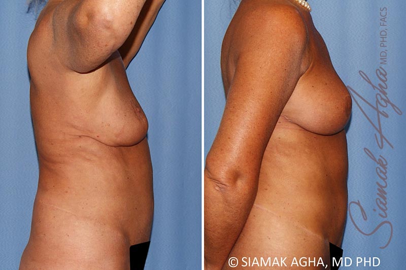 orange county breast lift with augmentation patient 12 right Newport Beach, CA