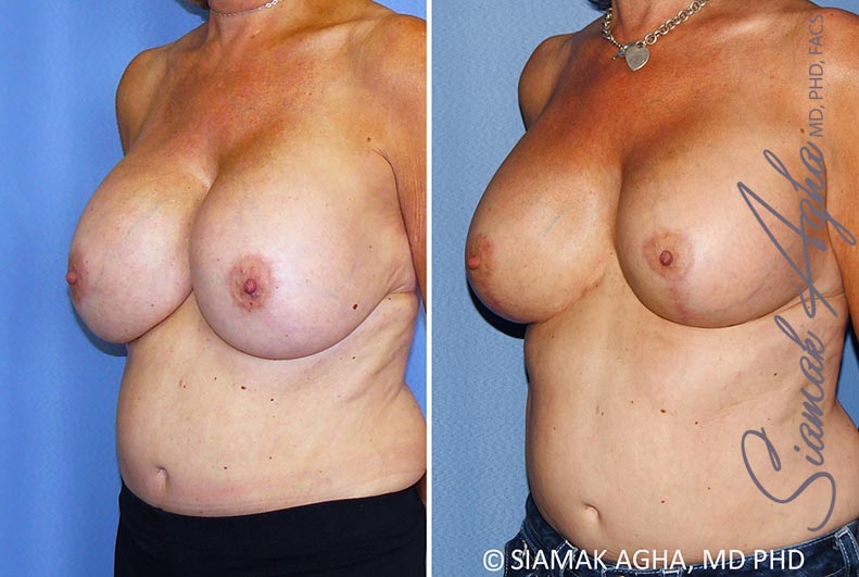 Breast Lift with Augmentation Patient 13