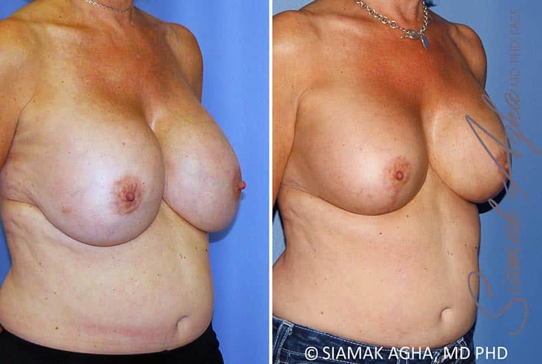 orange county breast lift with augmentation patient 13 front right Newport Beach, CA