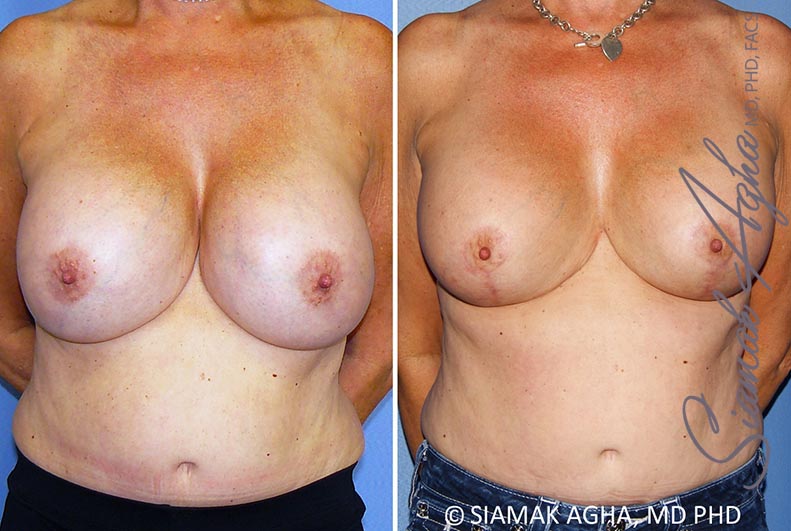 orange county breast lift with augmentation patient 13 front Newport Beach, CA