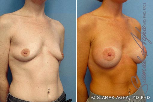 orange county breast lift with augmentation patient 2 front right Newport Beach, CA
