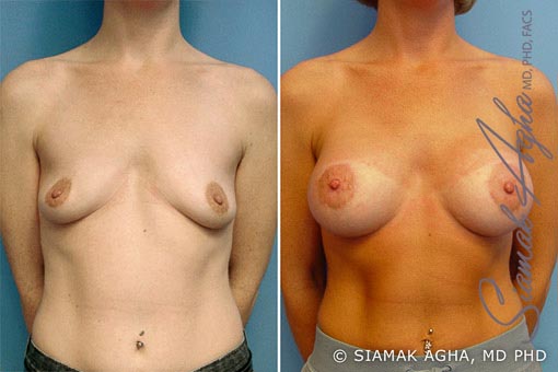 orange county breast lift with augmentation patient 2 front Newport Beach, CA