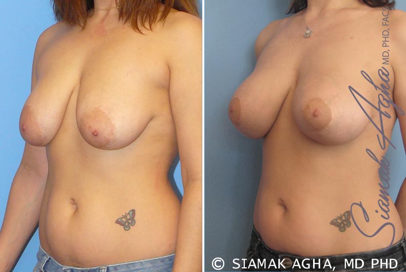 orange county breast lift with augmentation patient 3 front left Newport Beach, CA