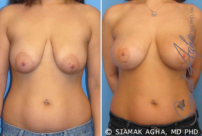 orange county breast lift with augmentation patient 3 front Newport Beach, CA