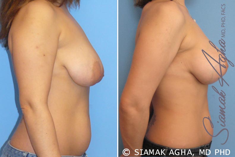orange county breast lift with augmentation patient 3 right Newport Beach, CA