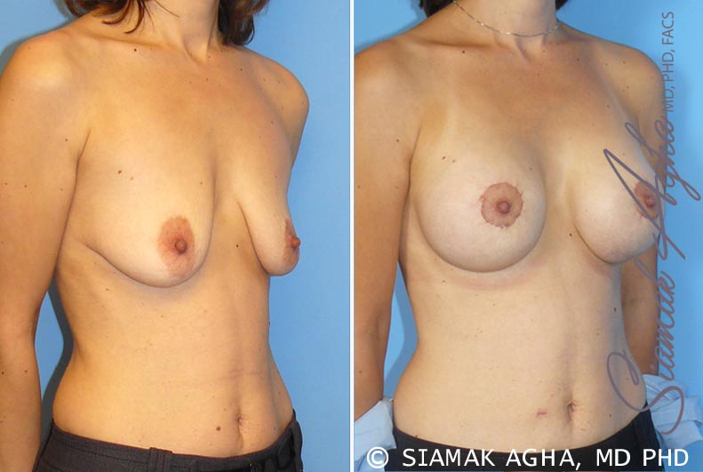 Breast Lift with Augmentation Patient 4