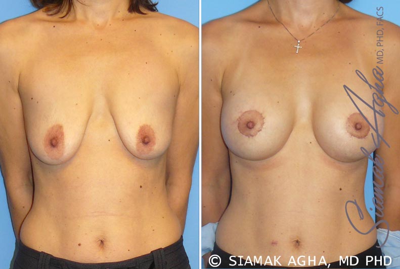 Breast Lift with Augmentation Patient 4
