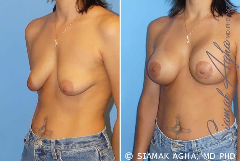 orange county breast lift with augmentation patient 5 front left Newport Beach, CA